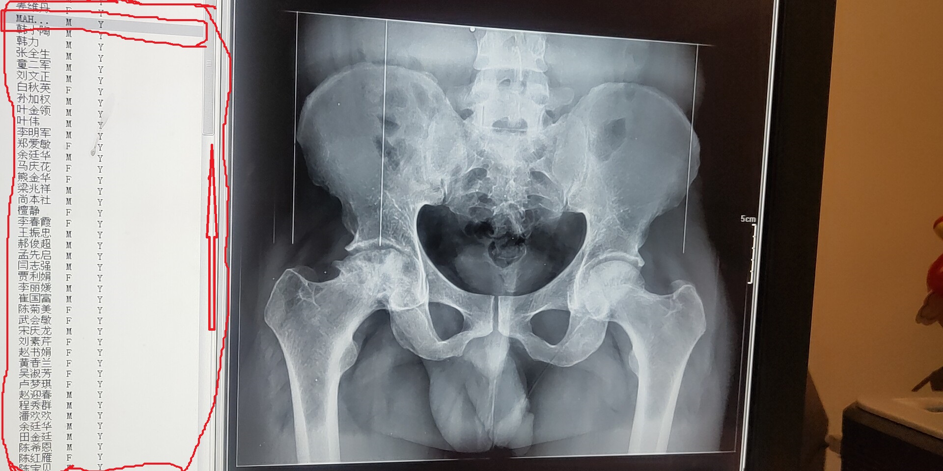 Hip Replacement Alternatives – Hip Replacement Option