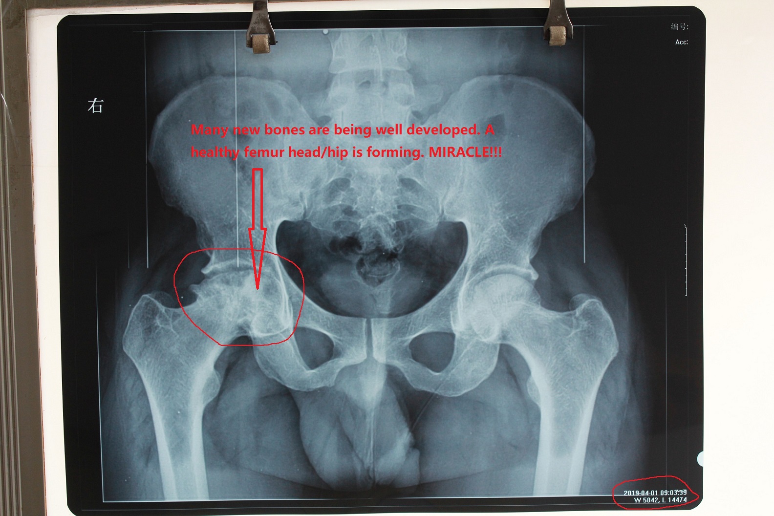 hip-replacement-alternatives-hip-replacement-option